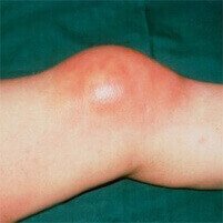 HondroFrost per borsite