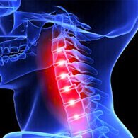 HondroFrost per dolore cervicale