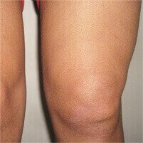 HondroFrost per sinovite